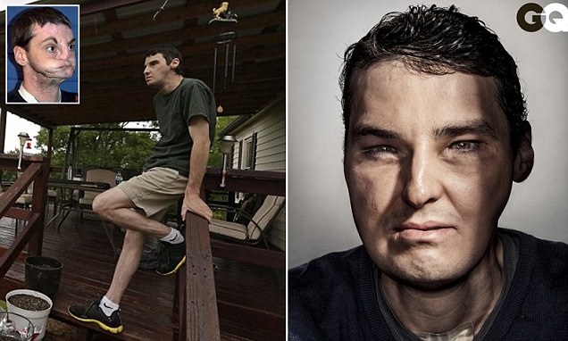 Парень с изуродованным лицом стал звездой GQ